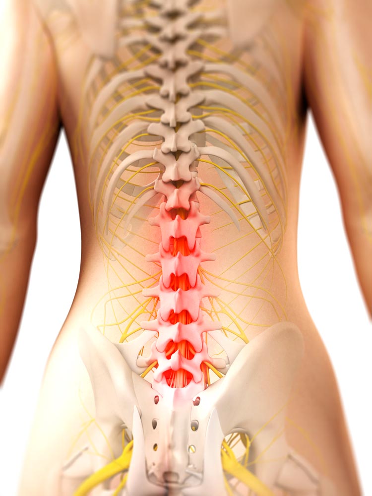 Pinched-Nerve-Pain-in-Spine